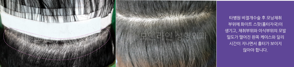 타병원 비절개수술 후 모낭채취 부위에 화이트 스팟(흉터자국)이 생기고, 채취부위와 이식부위의 모발 밀도가 떨어진 왼쪽 케이스와 달리 시간이 지나면서 흉터가 보이지 않아야 합니다.