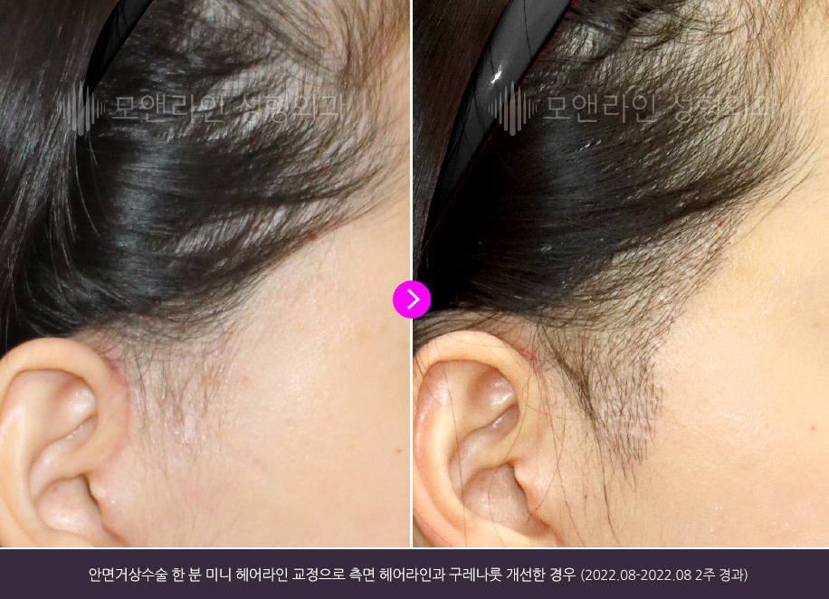 안면거상수술 한 분 미니 헤이러아니 교정으로 측면 헤어라인과 고레나룻 개선한 경우(2022.08-2022.08 2주 경과)