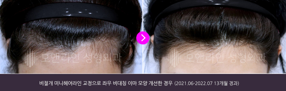 비절개 미니헤어라인 교정으로 좌우 비대칭 이마 모양 개선한 경우(2021.06-2022.07 13개월 경과)