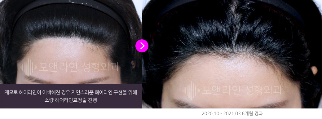 제모로 헤어라인이 어색해진 경우 자연스러운 헤어라인 구현을 위해 소량 헤어라인교정술 진행(2020.10 - 2021.03 6개월 경과)