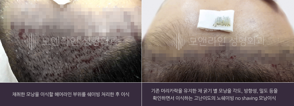 채취한 모낭을 이식할 헤어라인 부위를 쉐이빙 처리한 후 이식 / 기존 머리카락을 유지한 채 굵기 별 모낭을 각도, 방향성, 밀도 등을 확인하면서 이식하는 고난이도의 노쉐이빙 no shaving 모낭이식