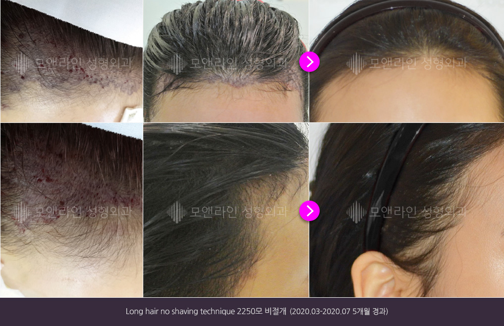 Long hair no shaving technique 2250모 비절개(2020.03-2020.07 5개월 경과)