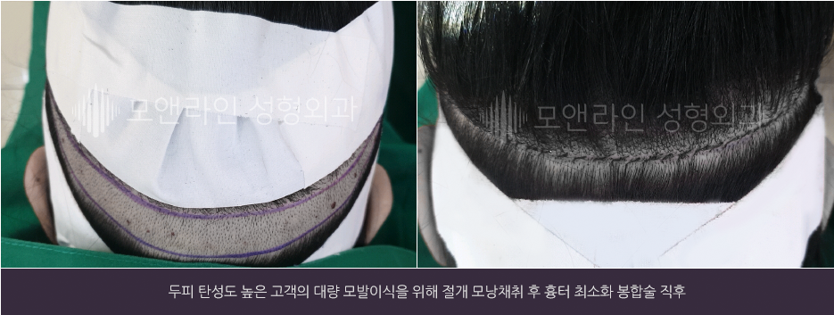 두피 탄성도 높은 고객의 대량 모발이식을 위해 절개 모낭채취 후 흉터 최소화 봉합술 직후