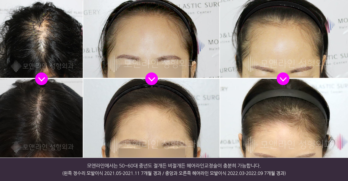 모앤라인에서는 50~60대 중년도 절개든 비절개든 헤어라인교정술이 충분히 가능합니다.(왼쪽 정수리 모발이식 2021.05-2021.11 7개월 경과 / 중앙과 오른쪽 헤어라인 모발이식 2022.03-2022.09 7개월 경과)