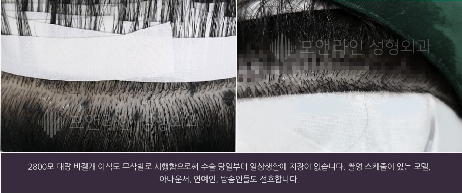 2800모 대량 비절개 이식도 무삭발로 시행함으로써 수술 당일부터 일상생활에 지장이 없습니다. 촬영 스케줄이 있는 모델, 아나운서, 연예인, 방송인들도 선호합니다.