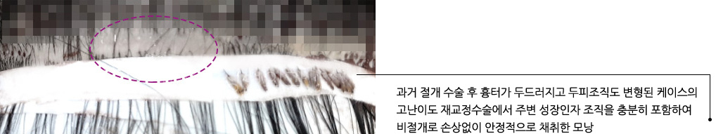 과거 절개 수술 후 흉터가 두드러지고 두피조직도 변형된 케이스의 고난이도 재교정수술에서 주변 성장인자 조직을 충분히 포함하여 비절개로 손상없이 안정적으로 채취한 모낭