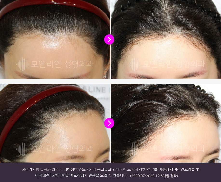헤어라인의 굴곡과 좌우 비대칭성이 과도하거나 동그랗고 인위적인 느낌이 강한 경우를 비롯해 헤어라인교정술 후 어색해진  헤어라인을 재교정해서 만족을 드릴 수 있습니다.(2020.07-2020.12 6개월 경과)