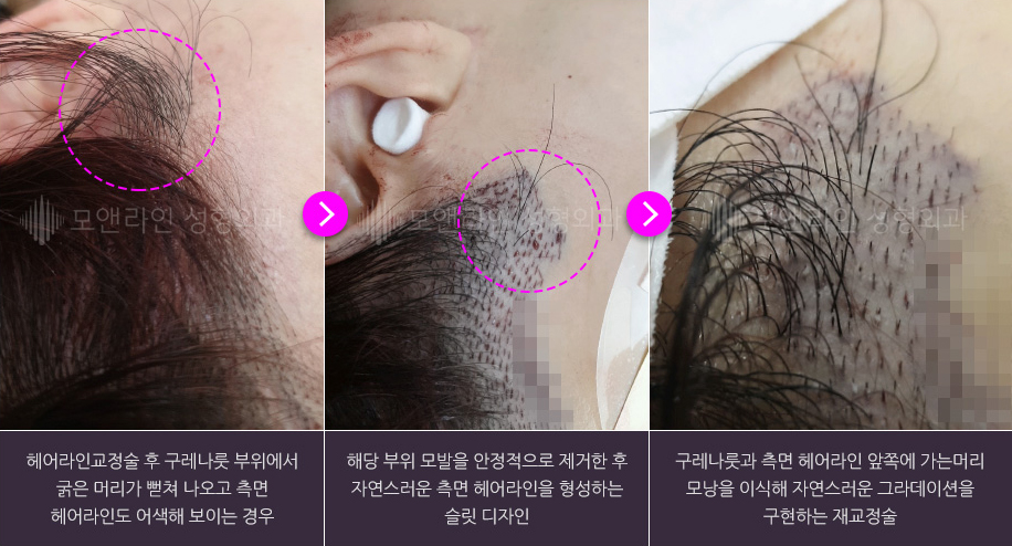 헤어라인교정술 후 구레나룻 부위에서 굵은 머리가 뻗쳐 나오고 측면 헤어라인도 어색해 보이는 경우 / 해당 부위 모발을 안정적으로 제거한 후 자연스러운 측면 헤어라인을 형성하는 슬릿 디자인 / 구레나룻과 측면 헤어라인 앞쪽에 가는머리 모낭을 이식해 자연스러운 그라데이션을 구현하는 재교정술