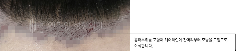 흉터부위를 포함해 헤어라인에 잔머리부터 모낭을 고밀도로 이식합니다.