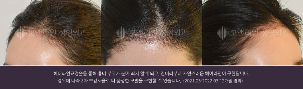 헤어라인교정술을 통해 흉터 부위가 눈에 띄지 않게 되고, 잔머리부터 자연스러운 헤어라인이 구현됩니다. 경우에 따라 2차 보강시술로 더 풍성한 모발을 구현할 수 있습니다.(2021.03-2022.03 12개월 경과)