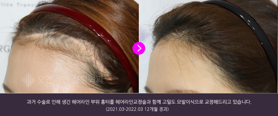과거 이마 보형물 삽입 성형술로 인해 생긴 두피 속 흉터를 헤어라인교정술과 함께 고밀도 모발이식으로 가릴 수 있습니다.(2021.03-2022.03 12개월 경과)