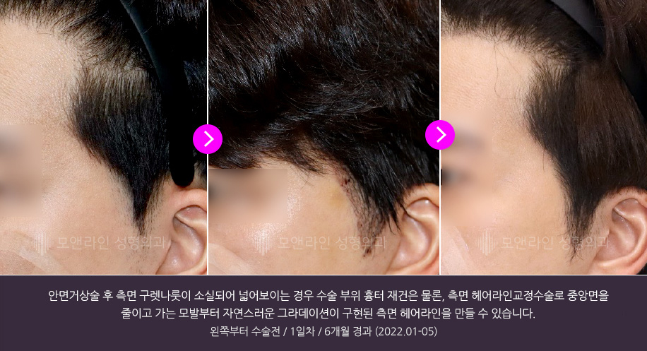 넓은 얼굴 축소를 위해 안면윤곽수술을 받았으나 중안부가 여전히 넓고 수술 흉터가 두드러지고 측면 잔머리가 소실되어 더 넓어 보이는 경우 측면 헤어라인교정술로 흉터를 가릴 뿐 아니라 넓은 중앙면을 줄이고 가는머리부터 자연스러운 그라데이션을 구현할 수 있습니다.왼쪽부터 수술전 / 1일차 / 6개월 경과 (2022.01-05)