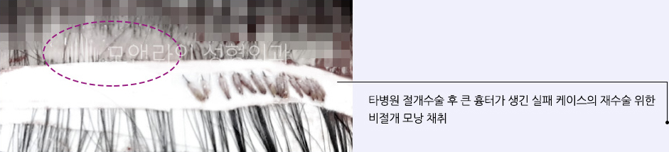 타병원 절개수술 후 큰 흉터가 생긴 실패 케이스의 재수술 위한 비절개 모낭 채취