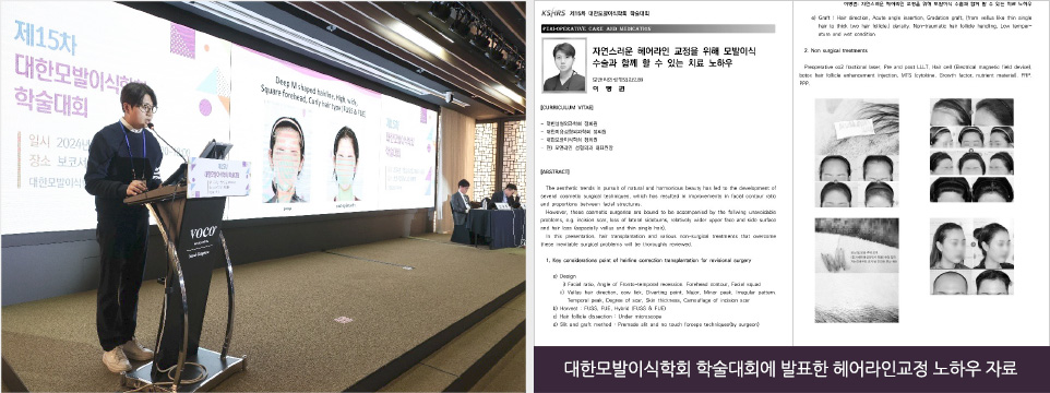 대한모발이식학회 학술대회에 발표한 헤어라인교정 노하우 자료