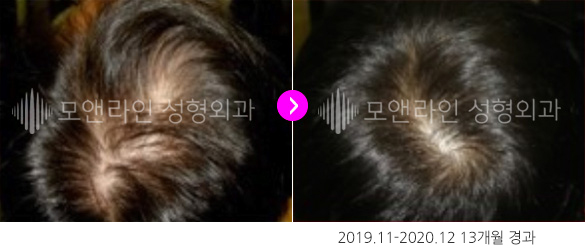 2019.11-2020.12 13개월 경과