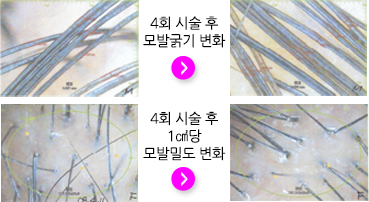 4회 시술 후 모발굵기 변화 비교 / 4회 시술 후 1㎠당 모발밀도 변화